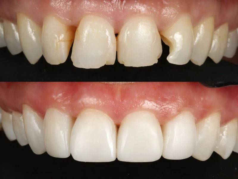 Before and after composite bonding on chipped front teeth at Twilight Dental